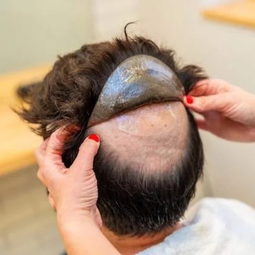 Cosmetic Hair System (Non-Surgical)